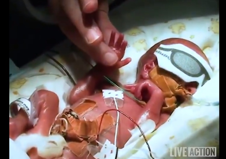 Video Zdrowe Dziecko Urodzilo Sie W 24 Tygodniu Ciazy Facebook Mial Ocenzurowac Film